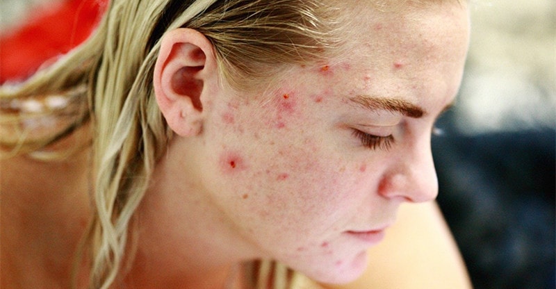 Zits Breakout? Right here’s What to Do About it