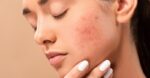 How To Determine Which Zits Pores and skin Therapy Is For You?