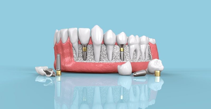 The Full Information To Dental Implants And Why They Are The Finest Approach To Change Lacking Enamel