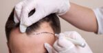 Prime 3 Locations in Turkey to Get a Hair Transplant